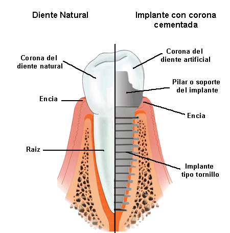 implantes-dentales.gif