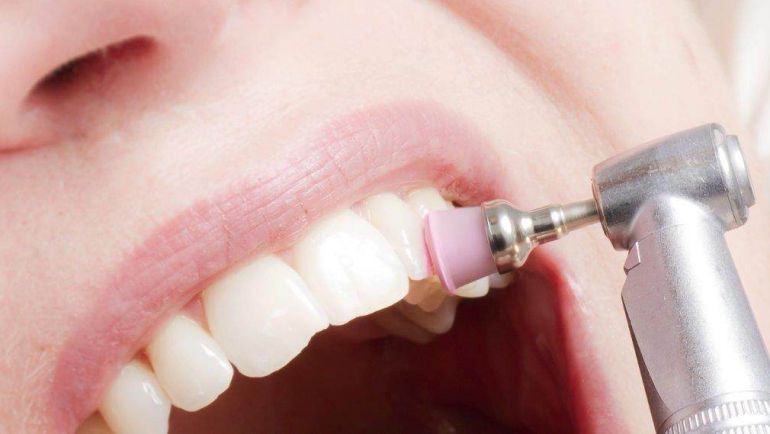 Profilaxis o Limpieza Dental