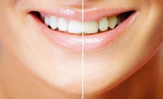 ¿Por qué amarillean los dientes a pesar del cepillado diario?